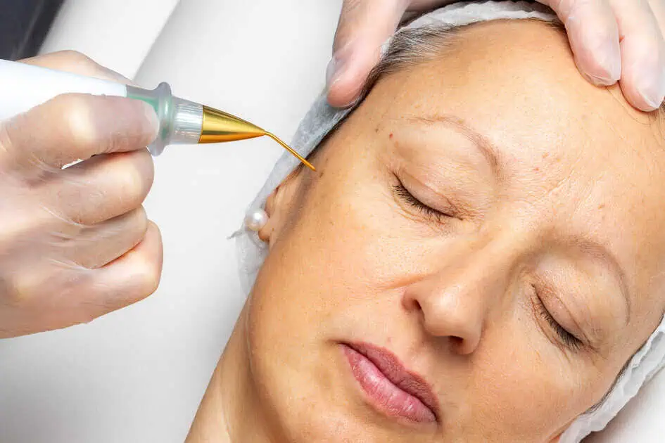 Plasma Pen by La Bonne Vie Family Healthcare & Aesthetics in 238 E Main St. Ville Platte, LA 70586