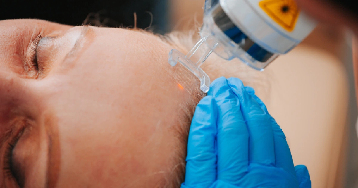 Woman Receiving CO2 Peel Treatment by La Bonne Vie Family Healthcare & Aesthetics in Ville Platte, LA